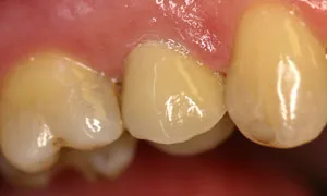 After Dental Crown by Family Dentist in Middletown DE