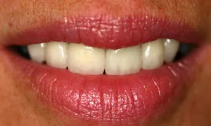 After Dental Crown by Family Dentist in Middletown DE