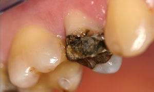 Before Dental Crown by Family Dentist in Middletown DE