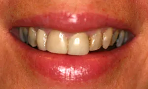 Before Dental Crown by Family Dentist in Middletown DE