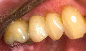 After Dental Implants by Family Dentist in Middletown DE