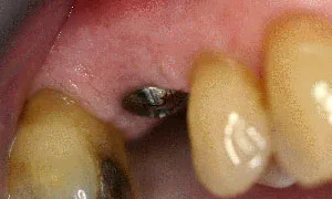 Before Dental Implants by Family Dentist in Middletown DE