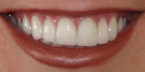 After Dental Veneers by Family Dentist in Middletown DE