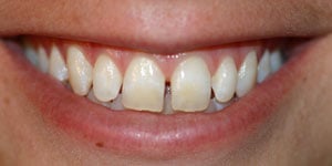 Before Dental Veneers by Family Dentist in Middletown DE