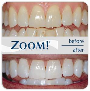 Zoom Whitening before and after image